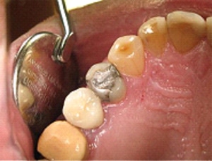 Remplacement d'un amalgame fracturé (plombage) par un composite esthétique  en technique indirecte. Le composite est un matériau bio compatible et  esthétique permettant de rétablir la fonction dentaire. Sa mise en œuvre est