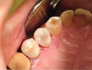 Enlever un amalgame dentaire (plombage) - Dentiste La Rochelle